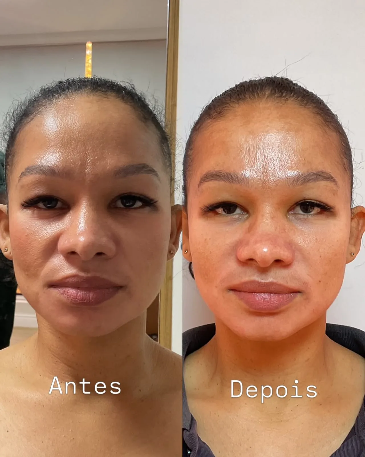 Antes e depois de tratamento facial: melhora visível na textura e uniformidade da pele.